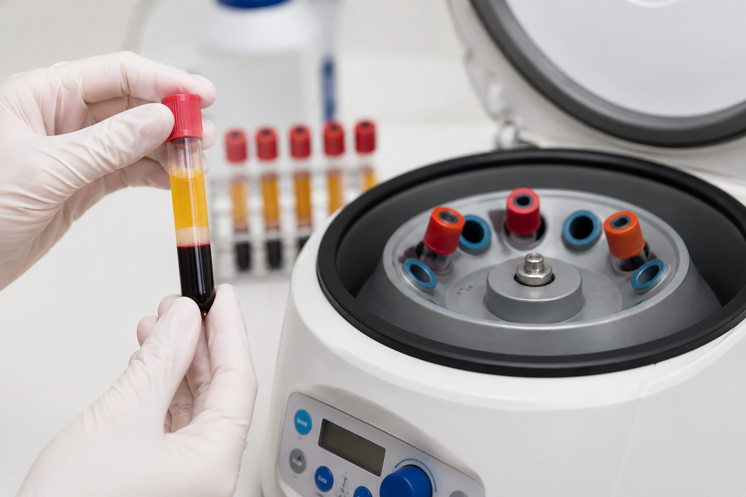 PRP (Platelet Rich Plasma) Uygulamaları